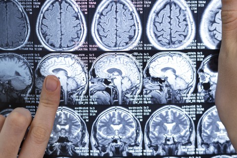 AVC: Acidente Vascular Cerebral causou quase 89 mil mortes no país em 2023